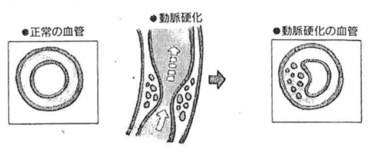 高脂血症とは？ | 八木内科クリニック